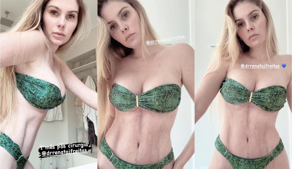 Bárbara Evans mostra o corpo um mês após cirurgias plásticas